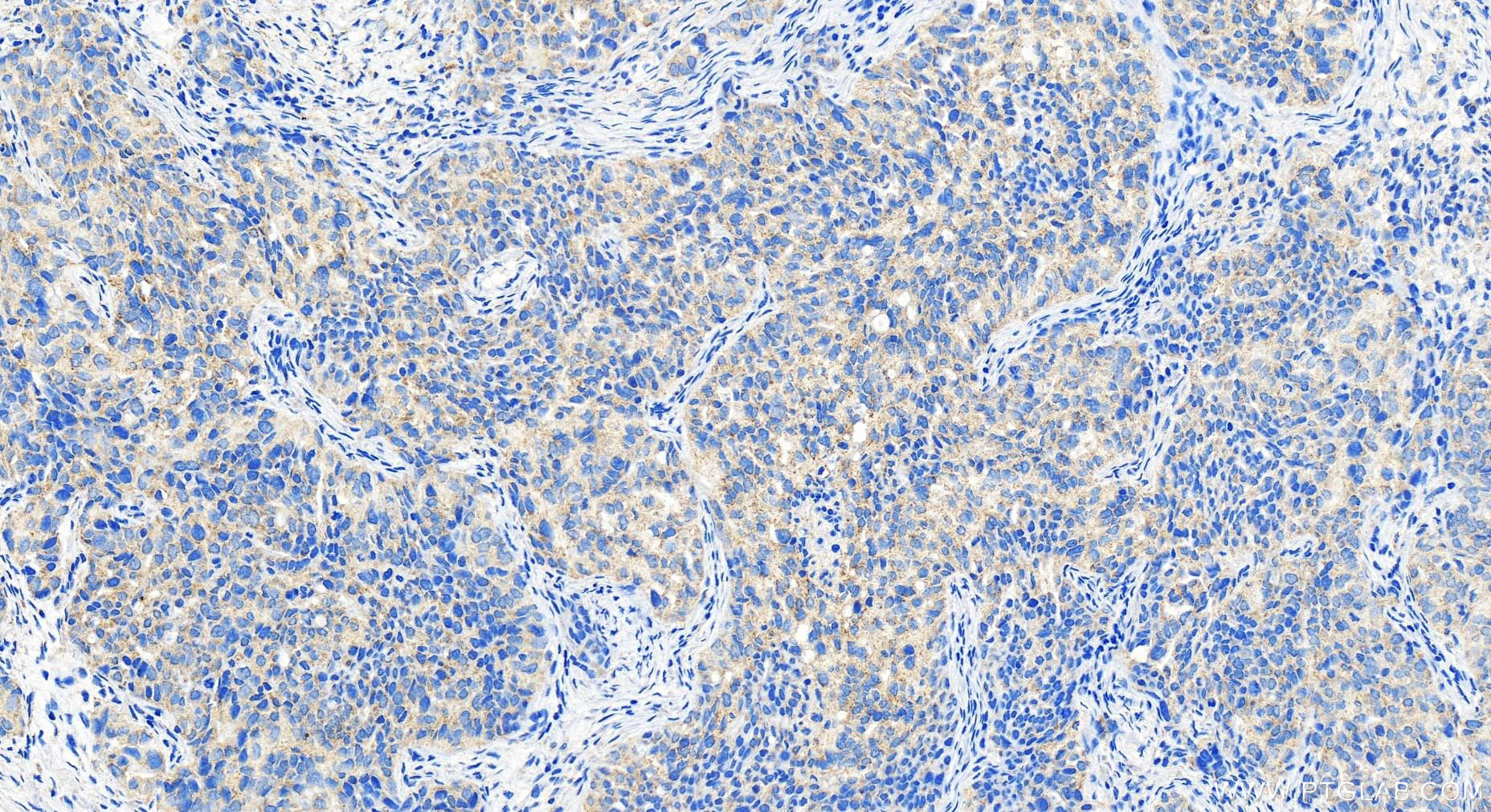 IHC staining of human ovary cancer using 20112-1-AP