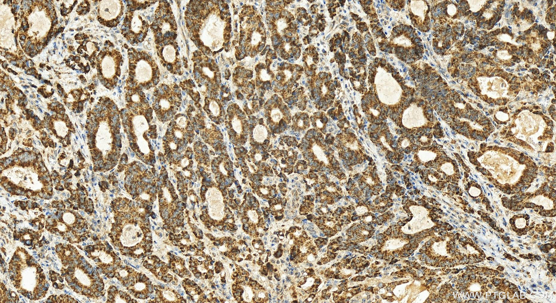 IHC staining of human stomach cancer using 21055-1-AP