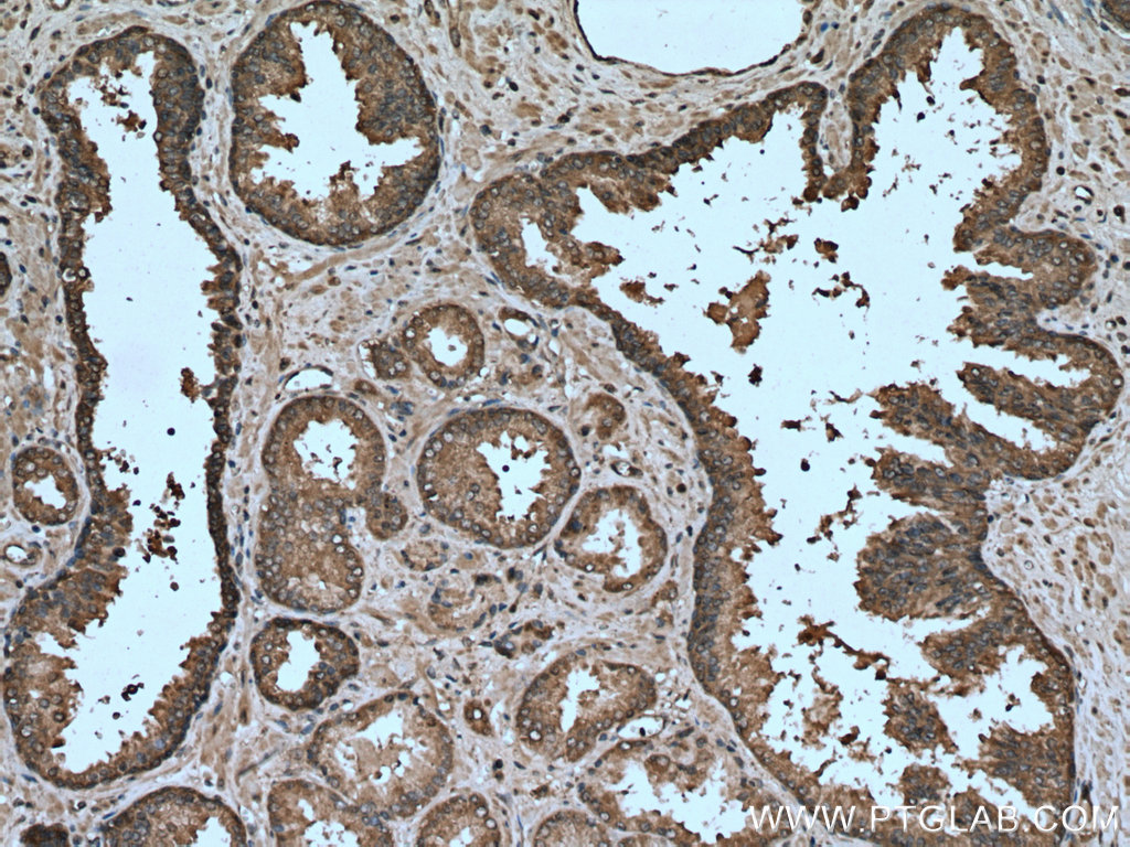 IHC staining of human prostate cancer using 15611-1-AP