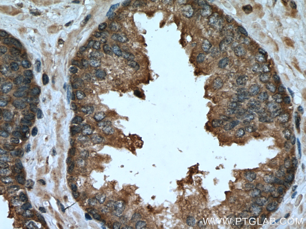 IHC staining of human prostate cancer using 15611-1-AP