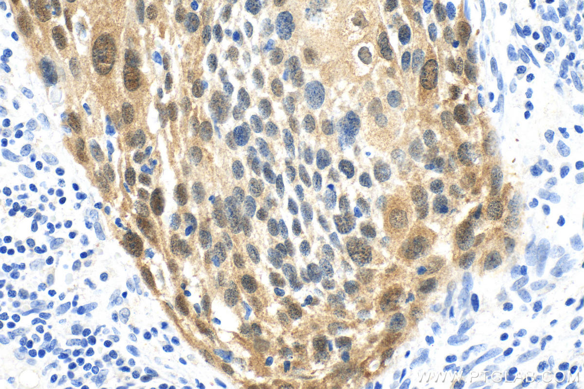 IHC staining of human cervical cancer using 10883-1-AP