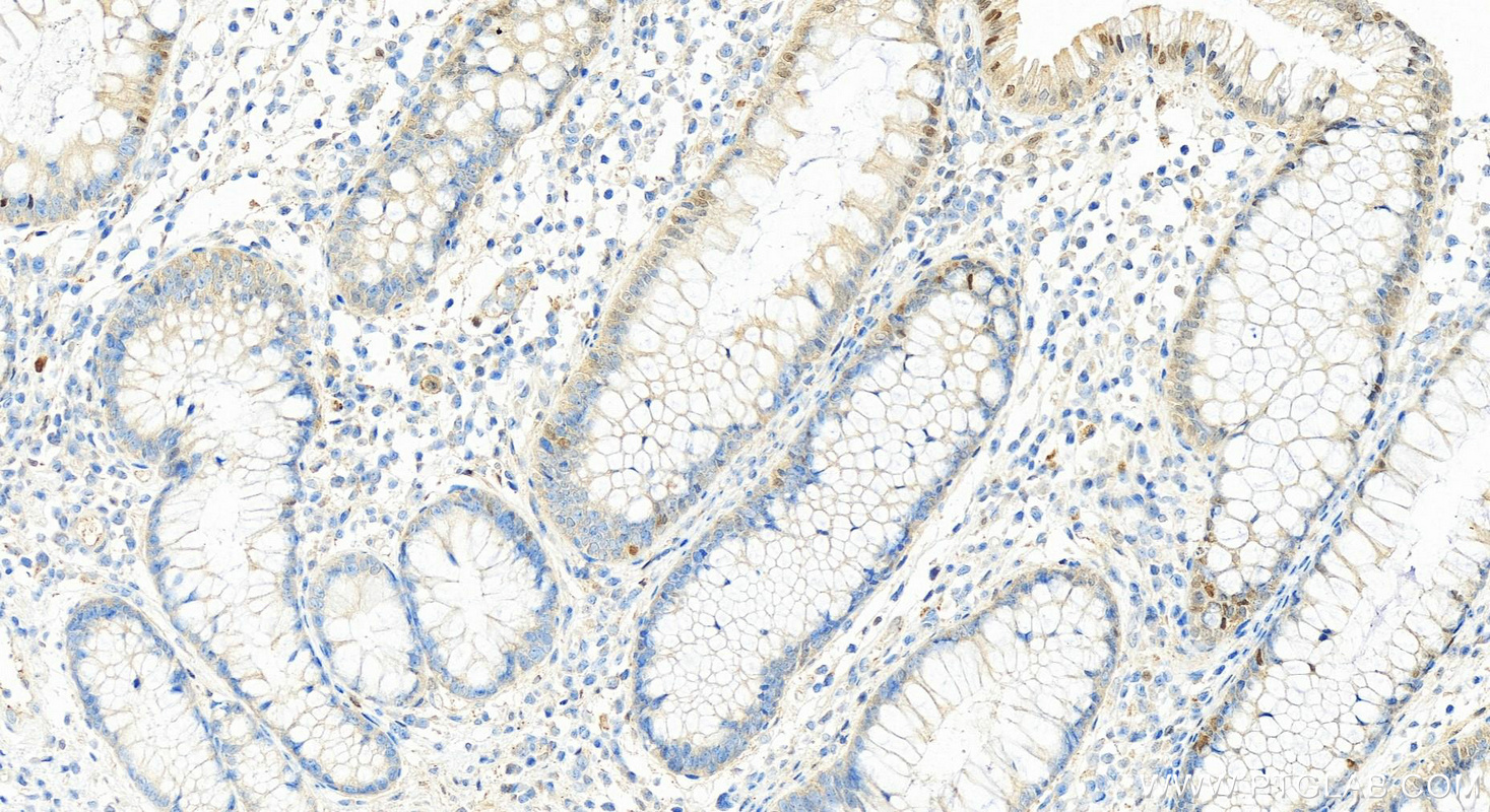 IHC staining of human colon cancer using 10355-1-AP