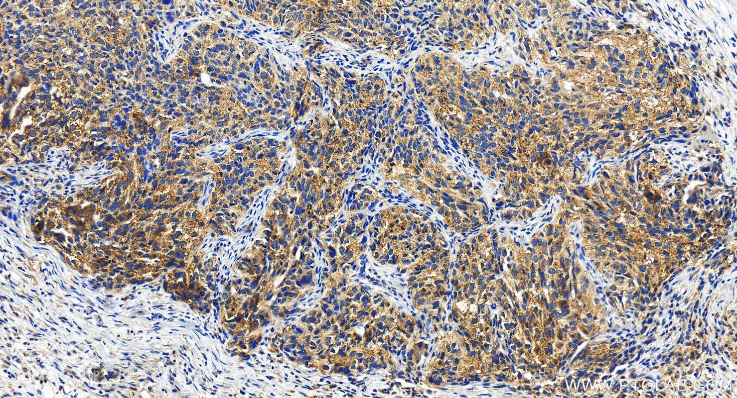 IHC staining of human ovary cancer using 13534-1-AP