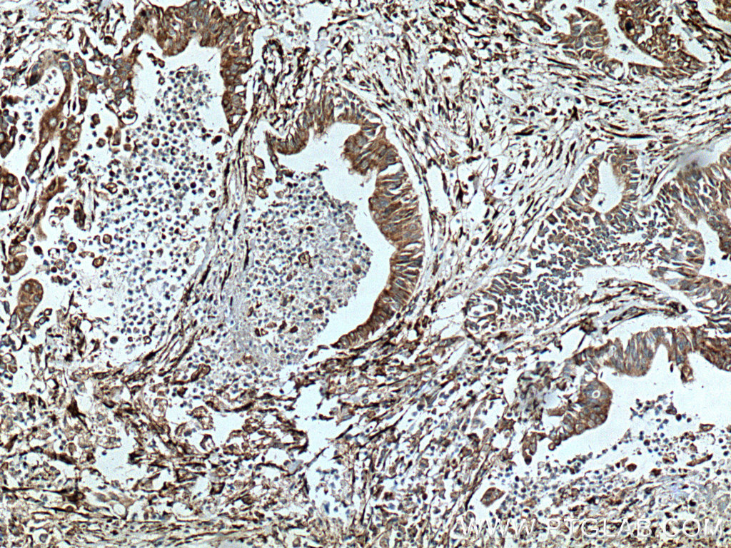 IHC staining of human pancreas cancer using 12658-1-AP