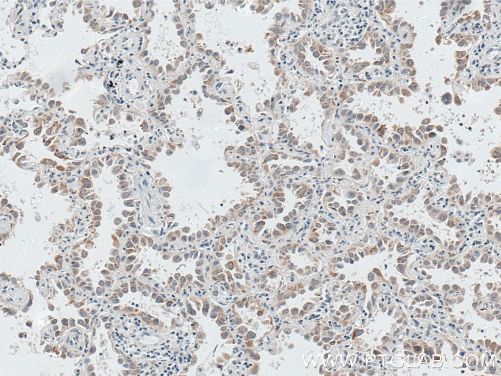 IHC staining of human lung cancer using 66604-1-Ig (same clone as 66604-1-PBS)