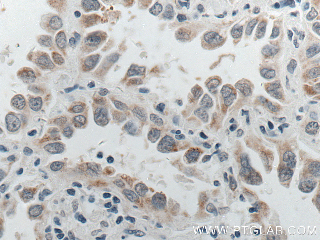 IHC staining of human lung cancer using 66604-1-Ig (same clone as 66604-1-PBS)