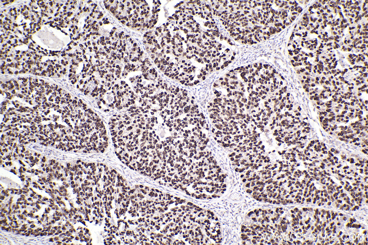 IHC staining of human ovary cancer using 60283-2-Ig