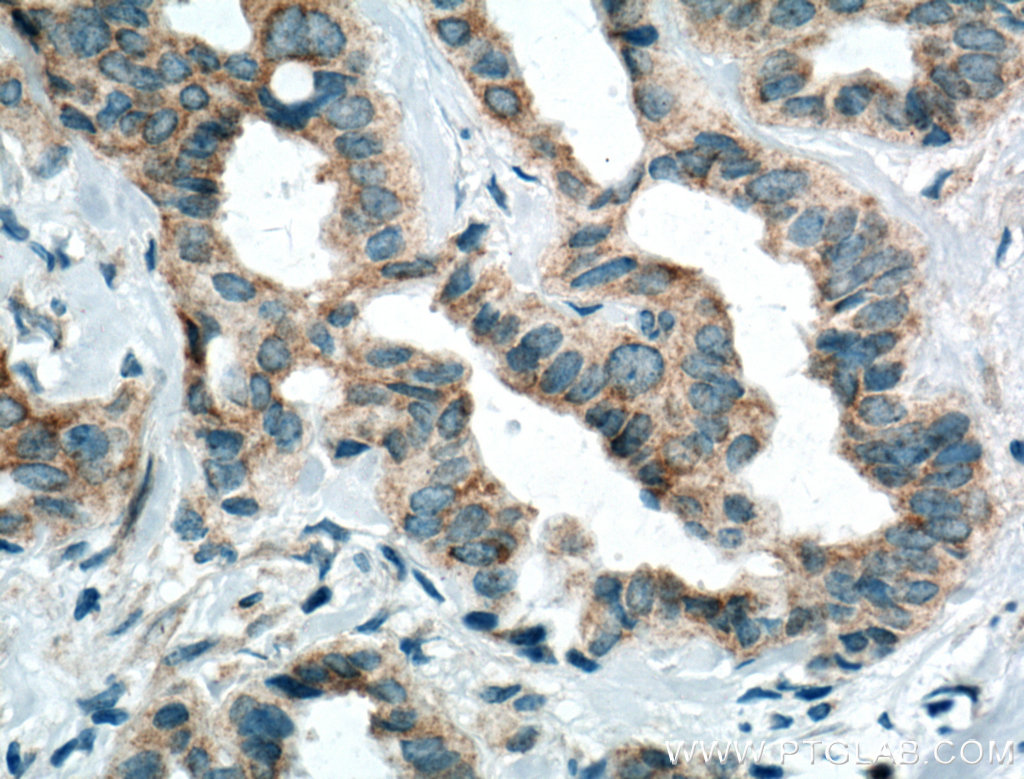 IHC staining of human breast cancer using 66055-1-Ig (same clone as 66055-1-PBS)