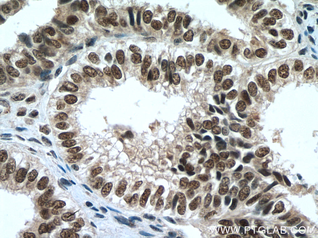 IHC staining of human ovary tumor using 15441-1-AP