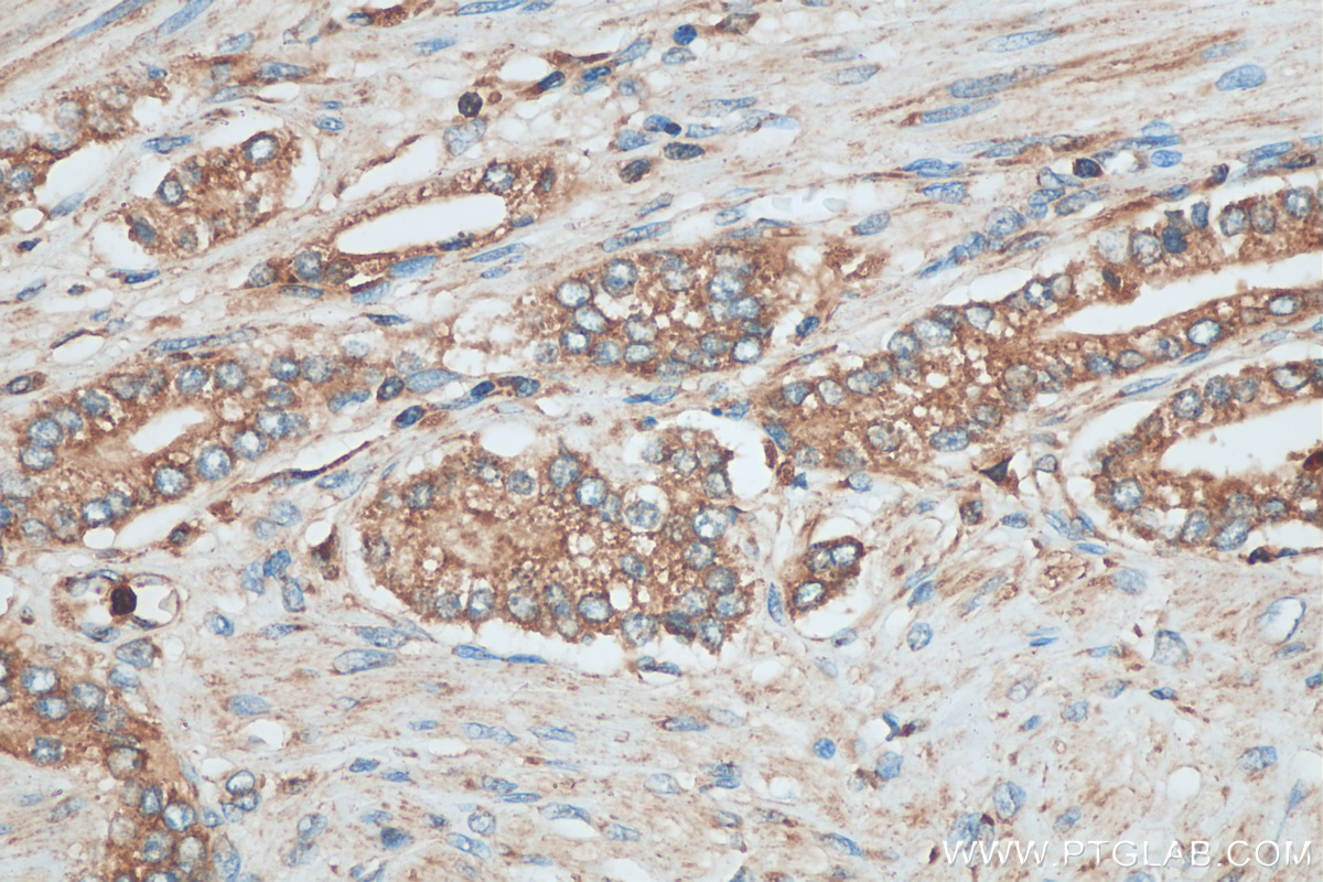 IHC staining of human prostate cancer using 29304-1-AP