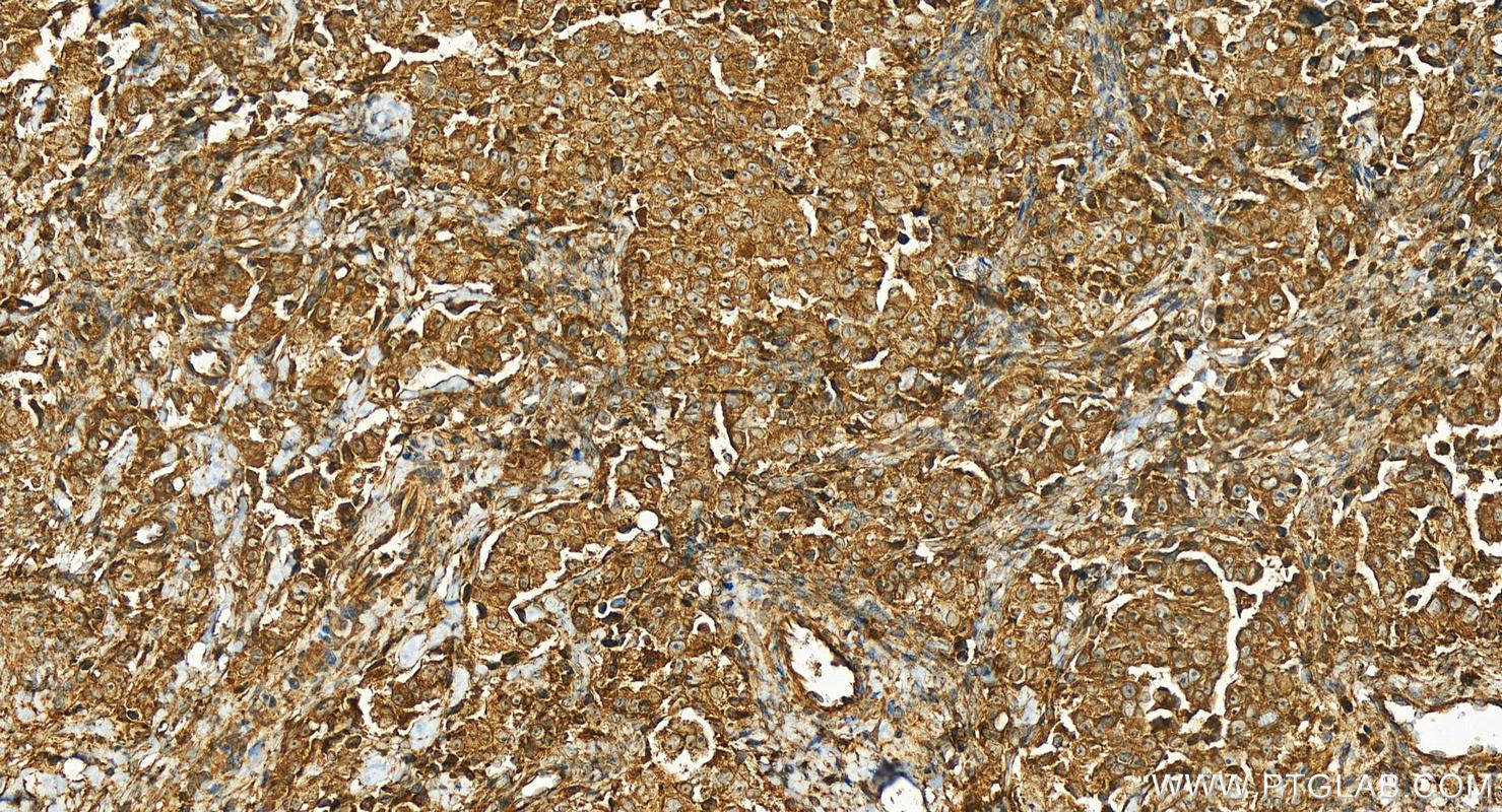 IHC staining of human ovary cancer using 25029-1-AP