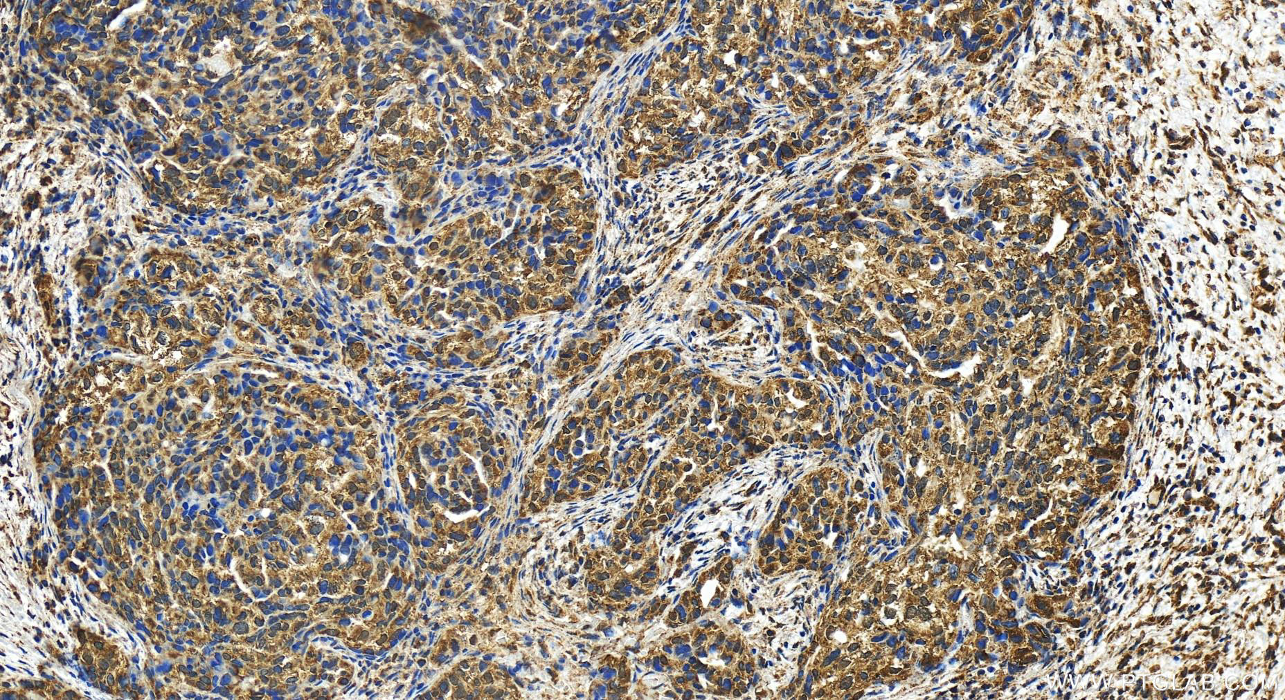 IHC staining of human ovary cancer using 15321-1-AP