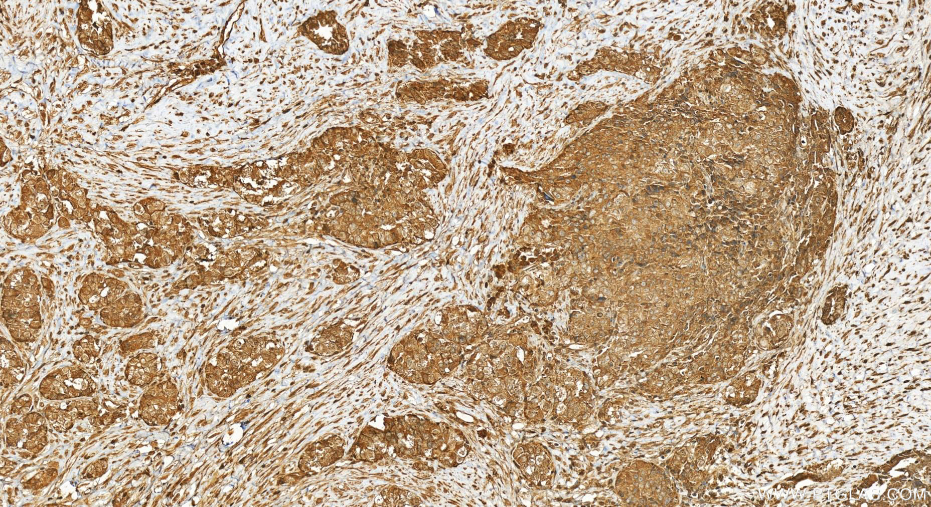 IHC staining of human ovary cancer using 25655-1-AP