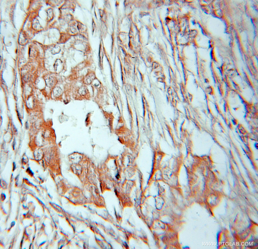 IHC staining of human lung cancer using 11001-1-AP