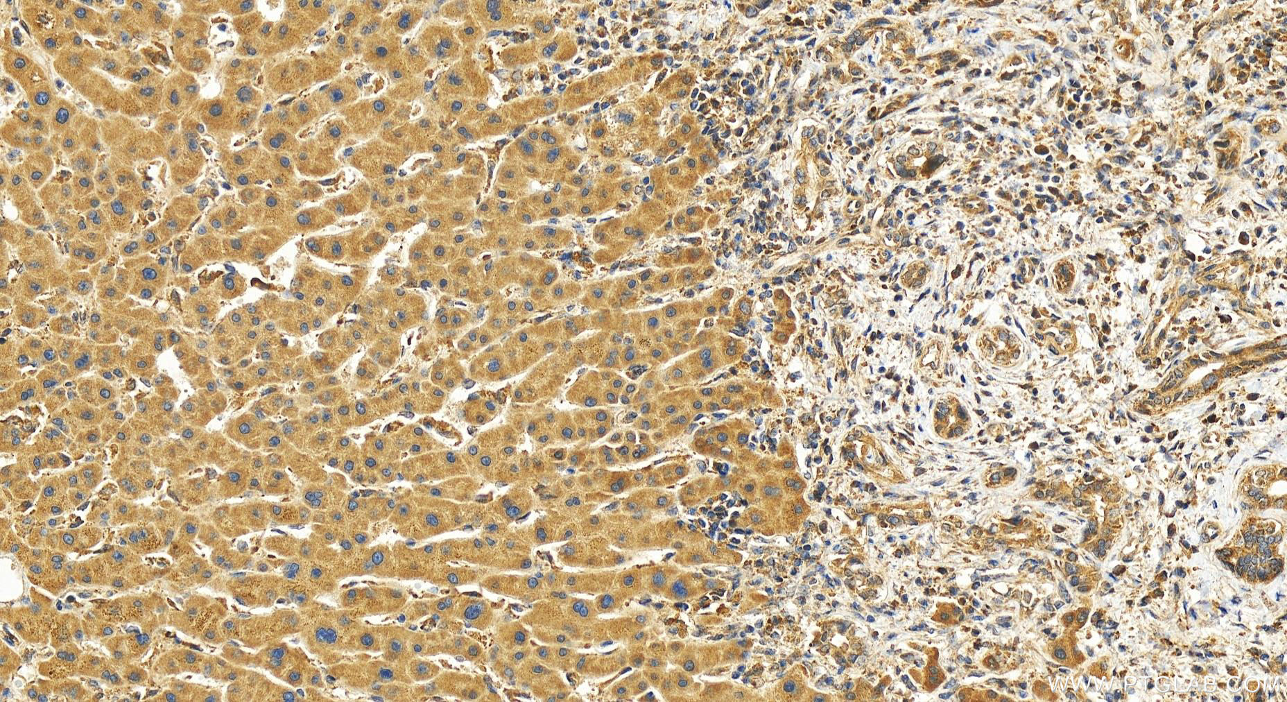 IHC staining of human intrahepatic cholangiocarcinoma using 26072-1-AP