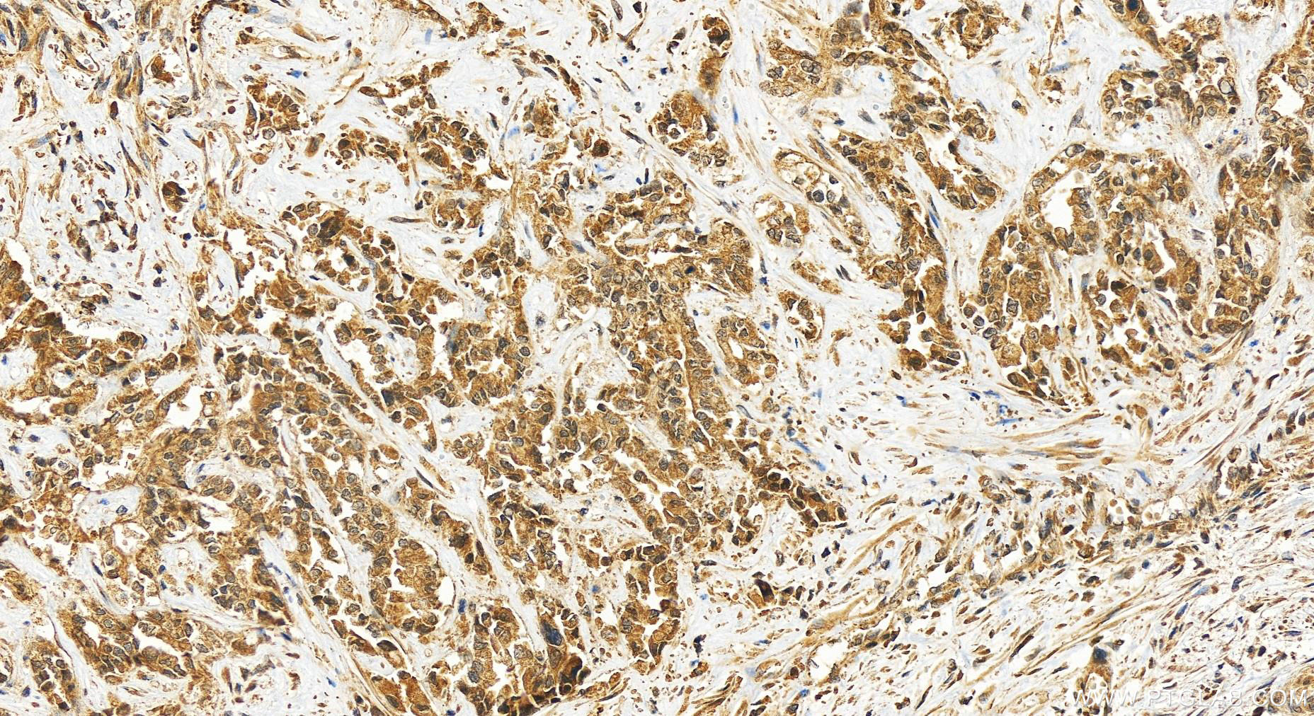 IHC staining of human intrahepatic cholangiocarcinoma using 26072-1-AP