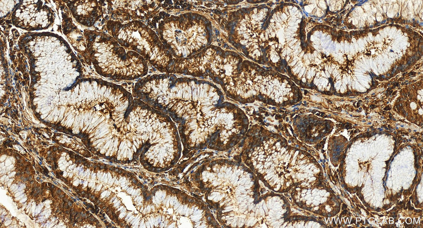 IHC staining of human stomach cancer using 55268-1-AP