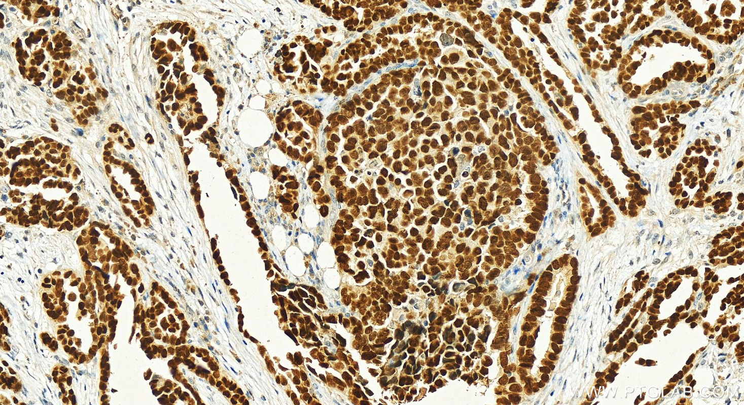 IHC staining of human ovary cancer using 10336-1-AP