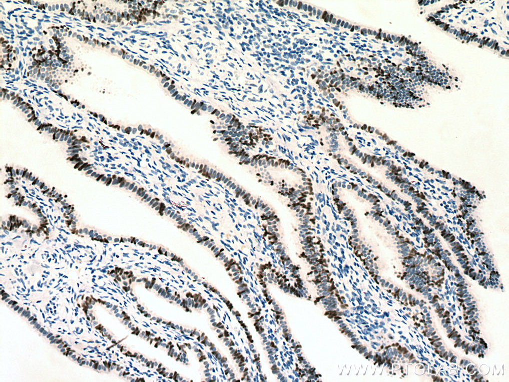 IHC staining of human ovary tumor using 80022-1-RR