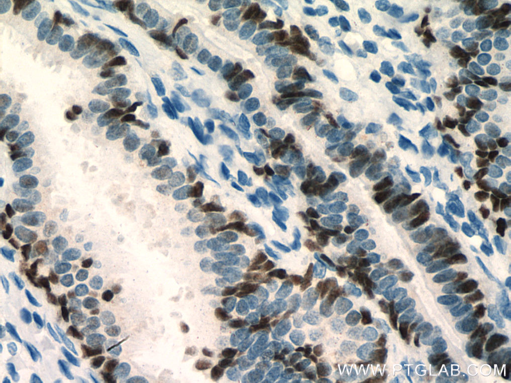 IHC staining of human ovary tumor using 80022-1-RR