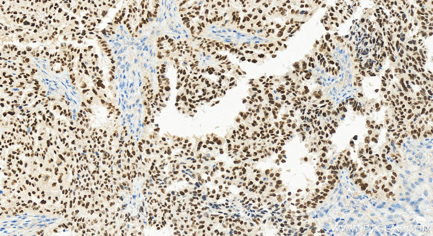 IHC staining of human ovary cancer using 80756-1-RR