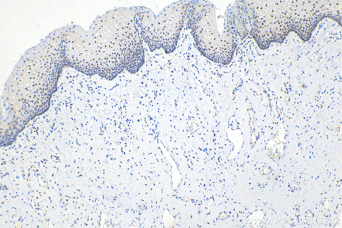 IHC staining of human cervical cancer using 18204-1-AP