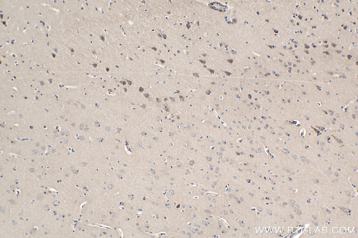 IHC staining of human gliomas using 25090-1-AP