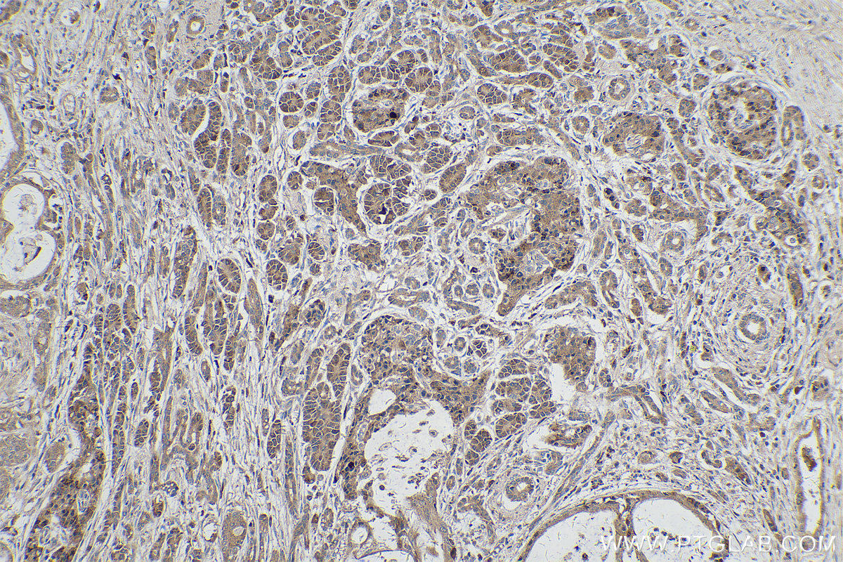 IHC staining of human pancreas cancer using 14785-1-AP