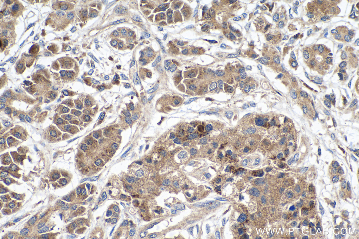 IHC staining of human pancreas cancer using 14785-1-AP