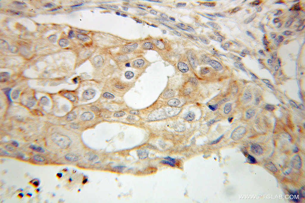 IHC staining of human breast cancer using 10857-1-AP