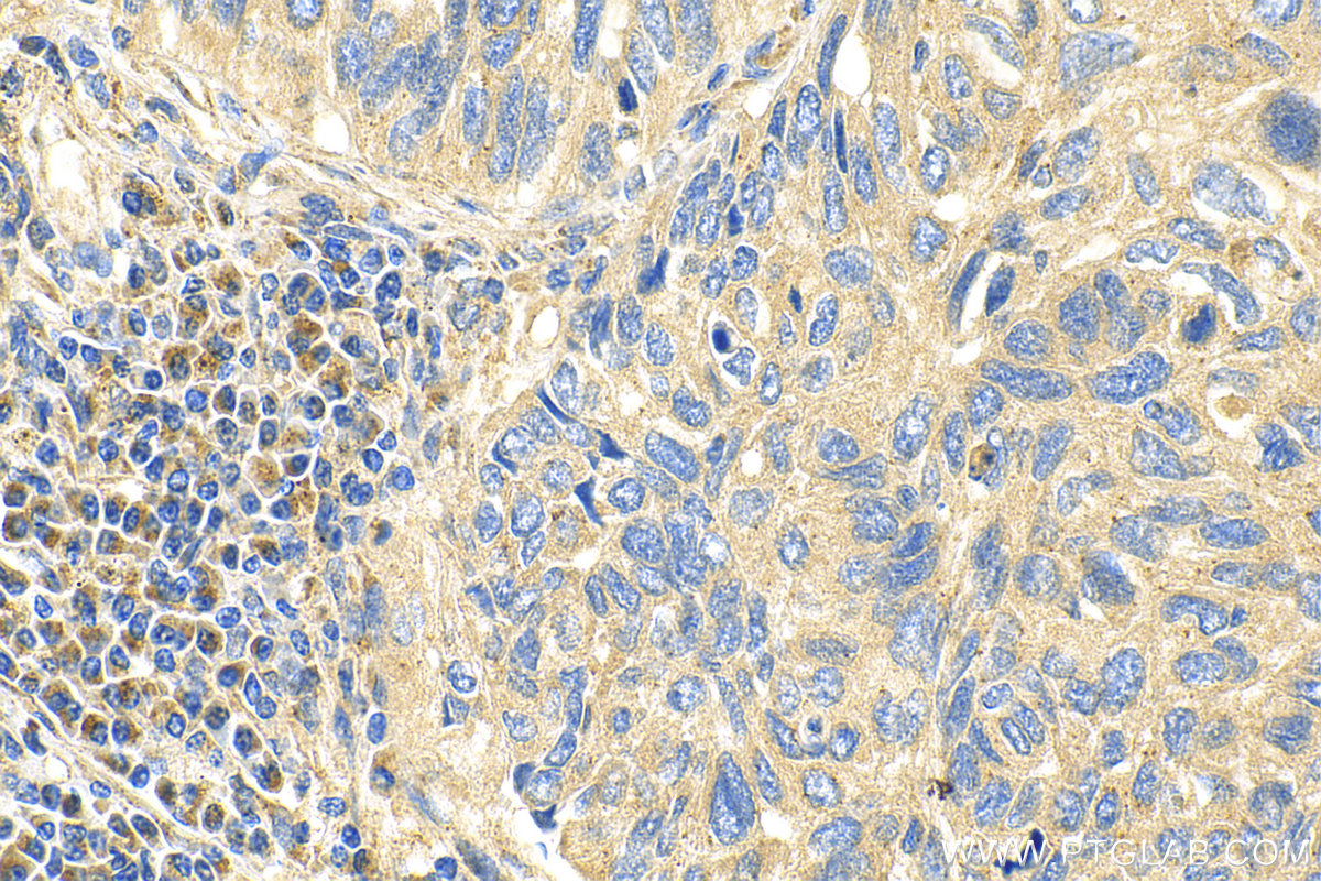 IHC staining of human lung cancer using 23848-1-AP