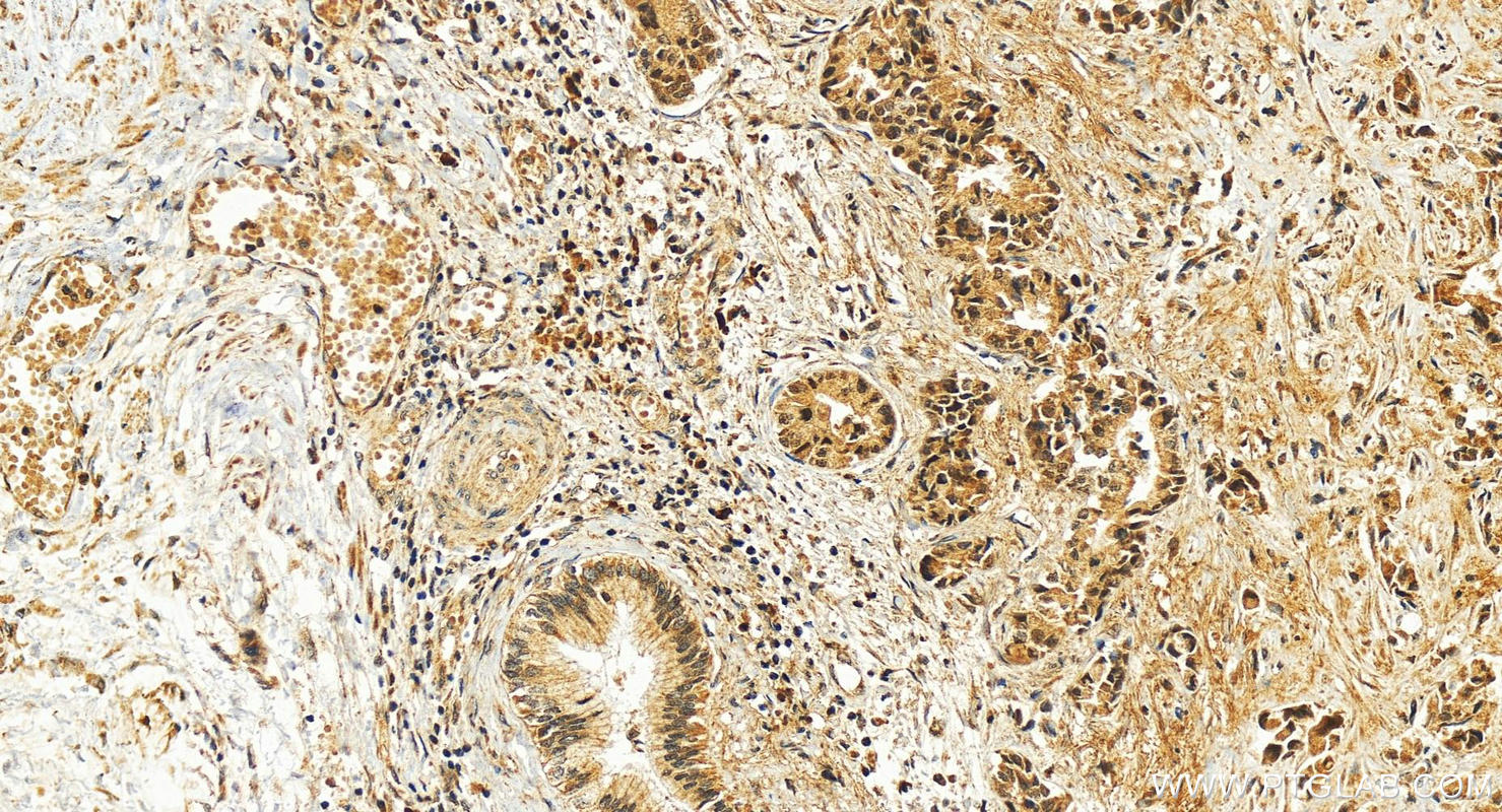 IHC staining of human intrahepatic cholangiocarcinoma using 23540-1-AP