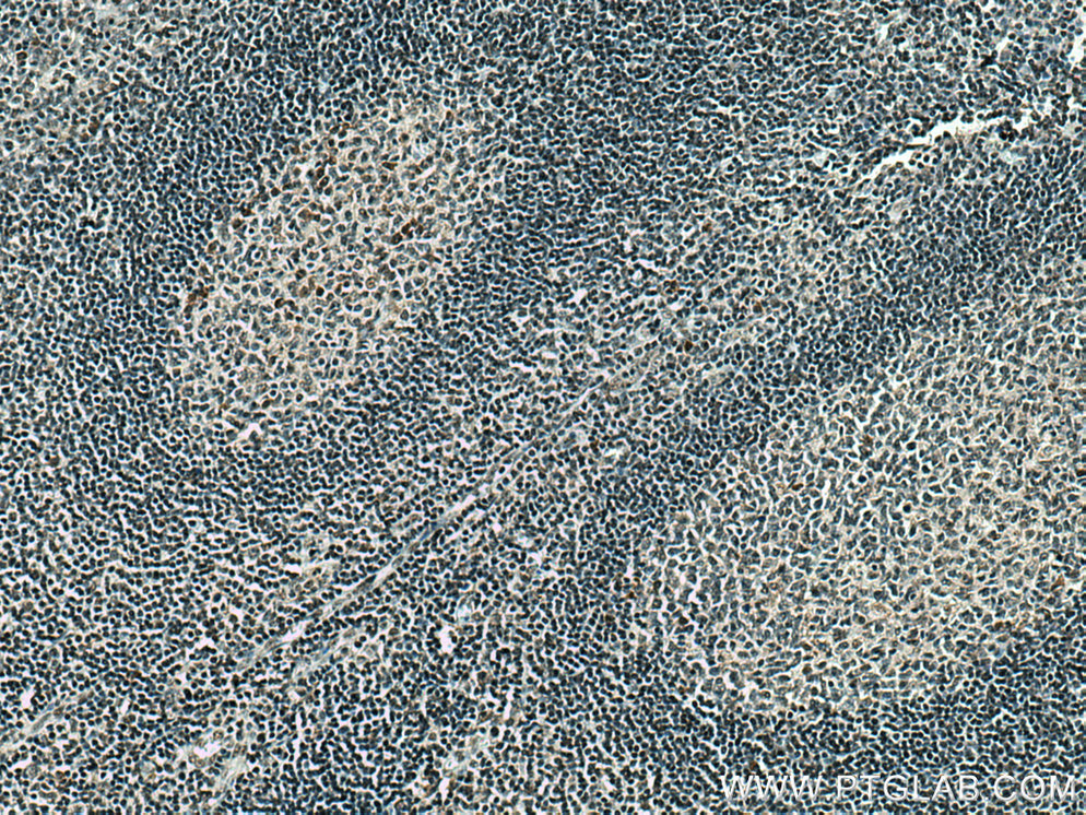 IHC staining of human tonsillitis using 16082-1-AP