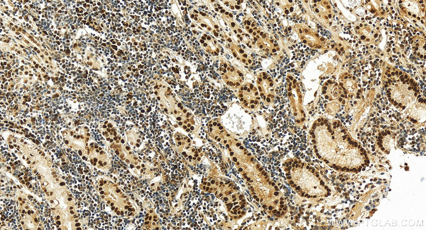 IHC staining of human stomach cancer using 24036-1-AP