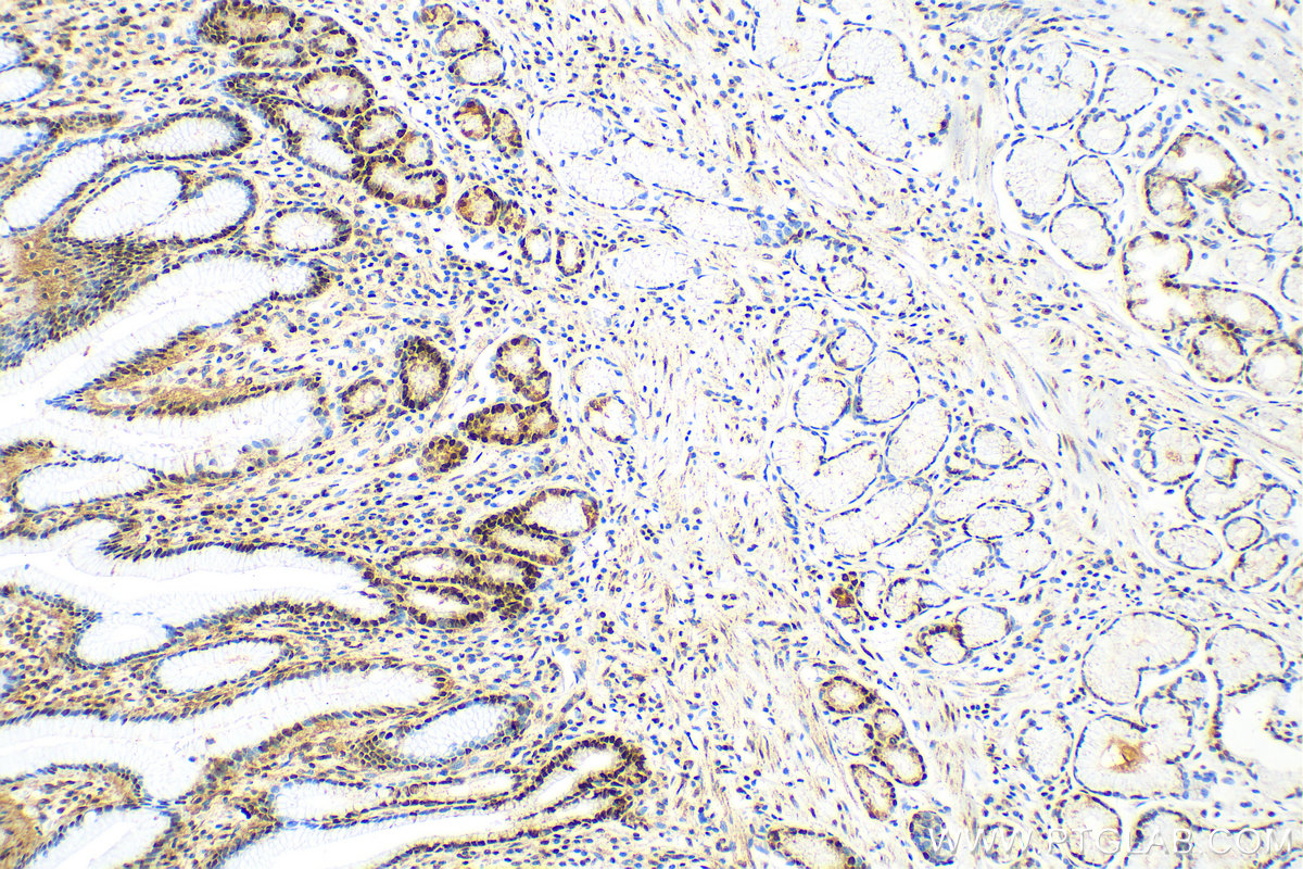 IHC staining of human stomach cancer using 81302-6-RR