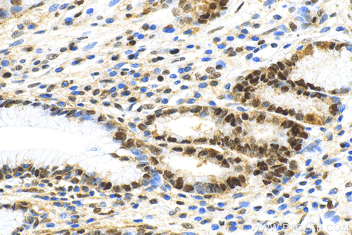 IHC staining of human stomach cancer using 81302-6-RR