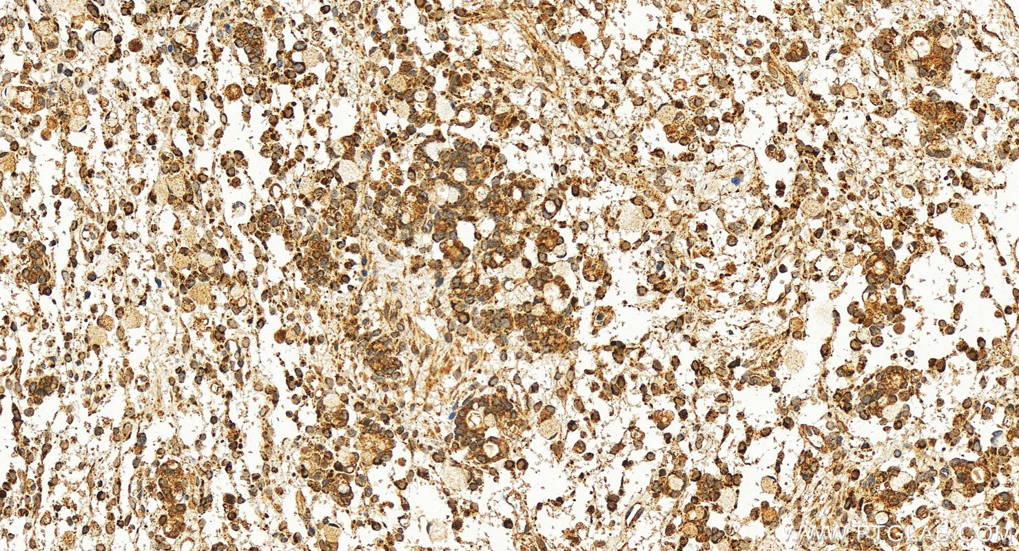 IHC staining of human ovary cancer using 12207-1-AP