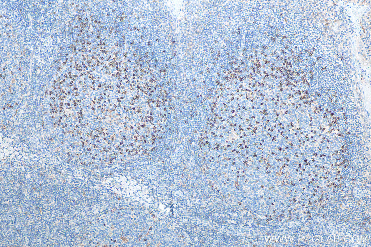 IHC staining of human tonsillitis using 66220-1-Ig