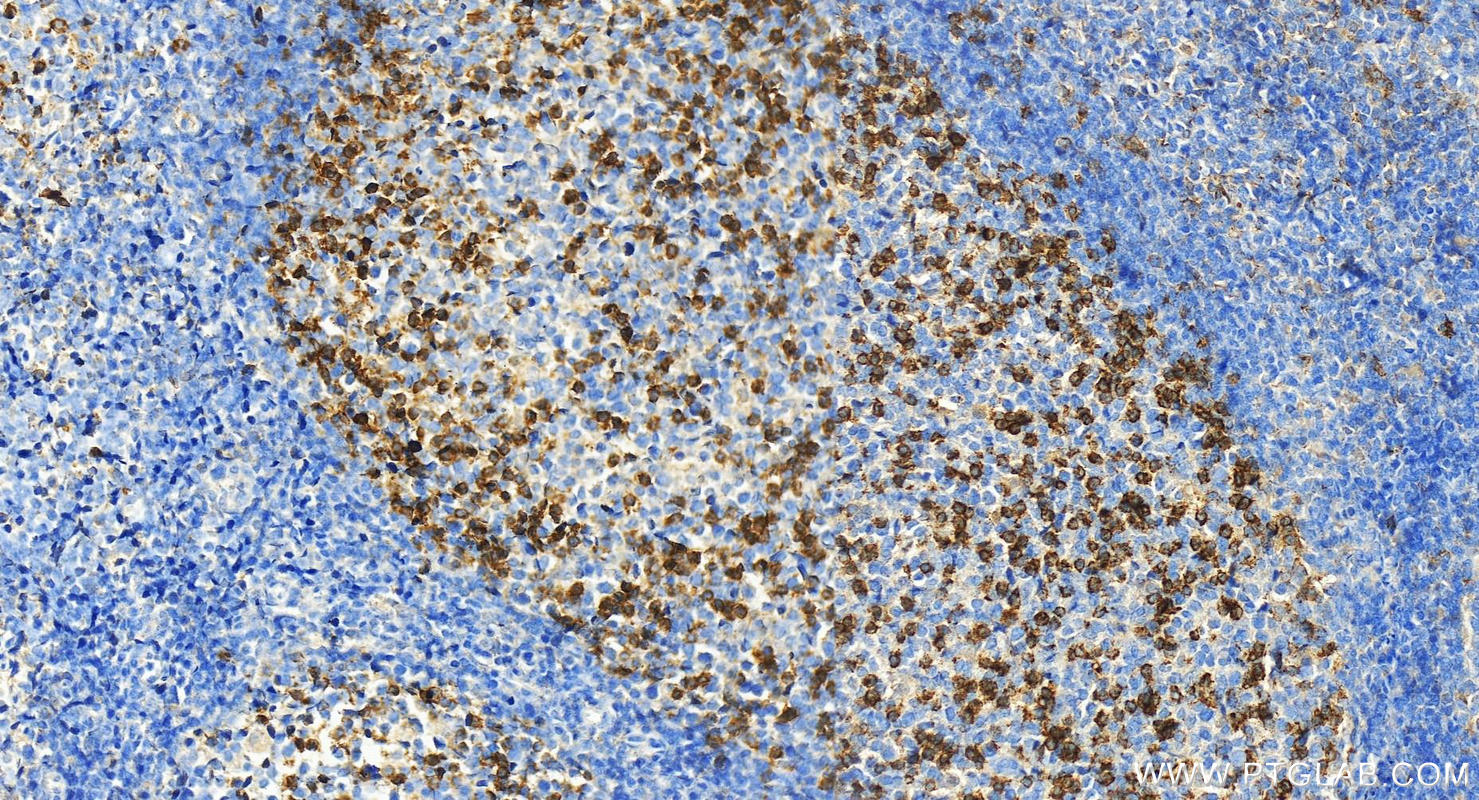 IHC staining of human tonsillitis using 66220-1-Ig