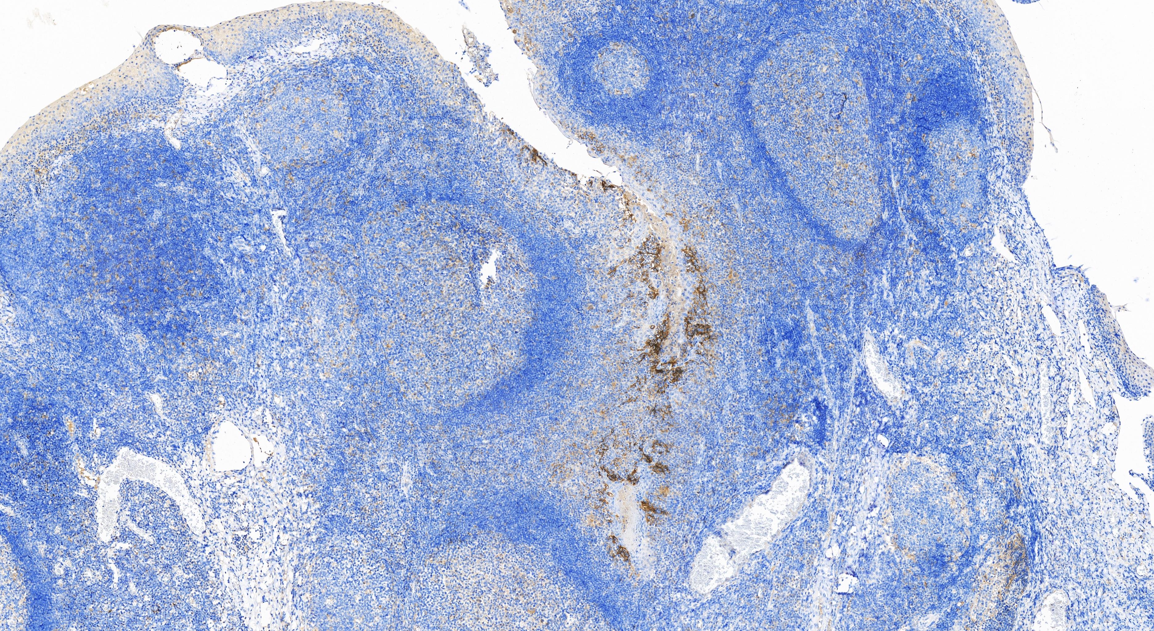 IHC staining of human tonsillitis using 82719-13-RR