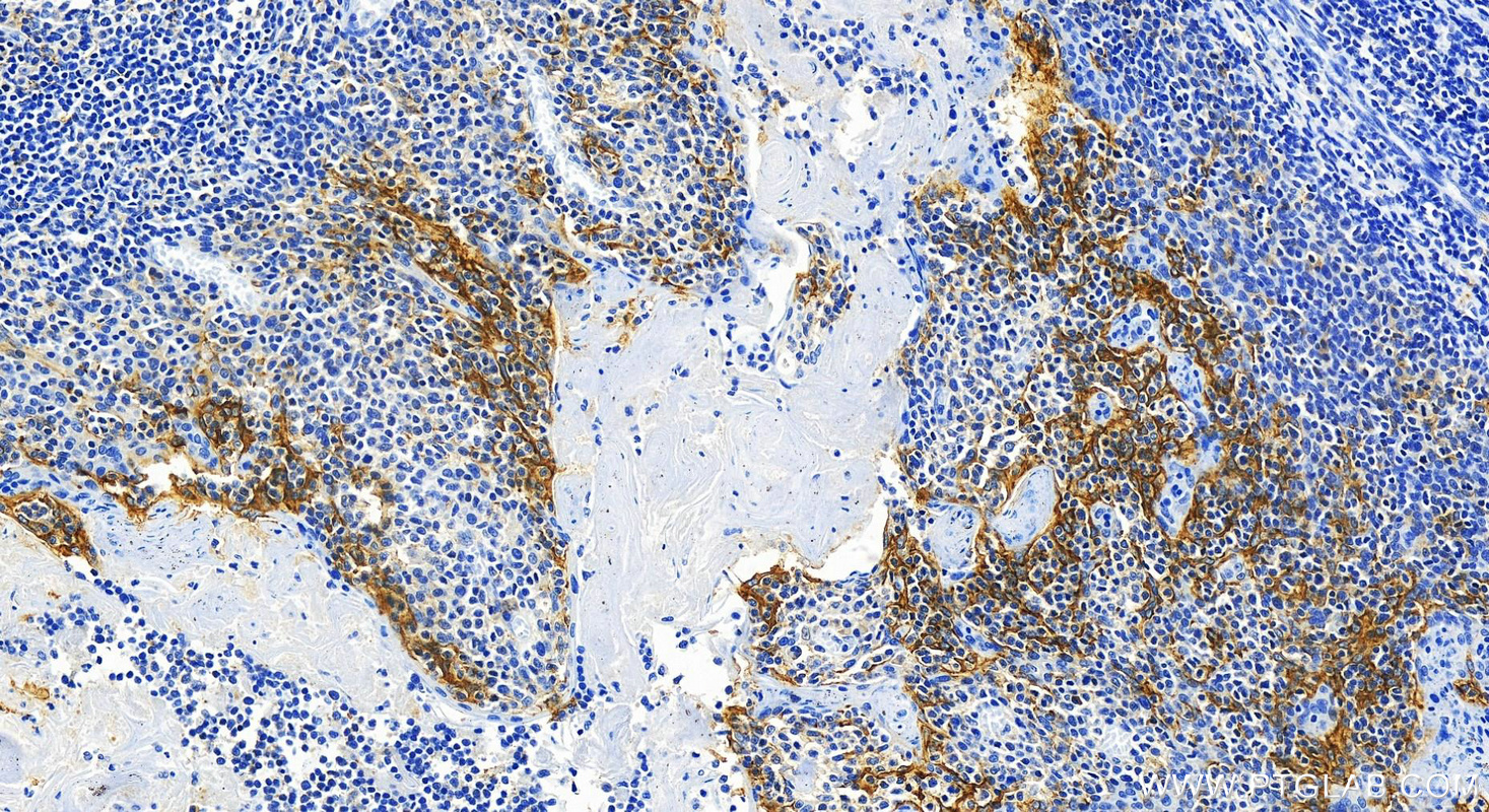 IHC staining of human tonsillitis using 82719-15-RR (same clone as 82719-15-PBS)