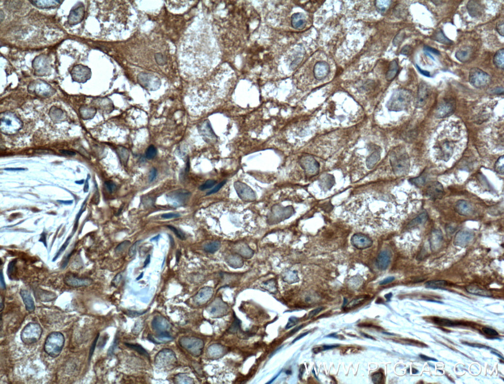 IHC staining of human breast cancer using 15081-1-AP