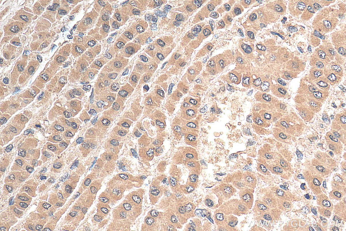 IHC staining of human liver cancer using 66100-1-Ig (same clone as 66100-1-PBS)