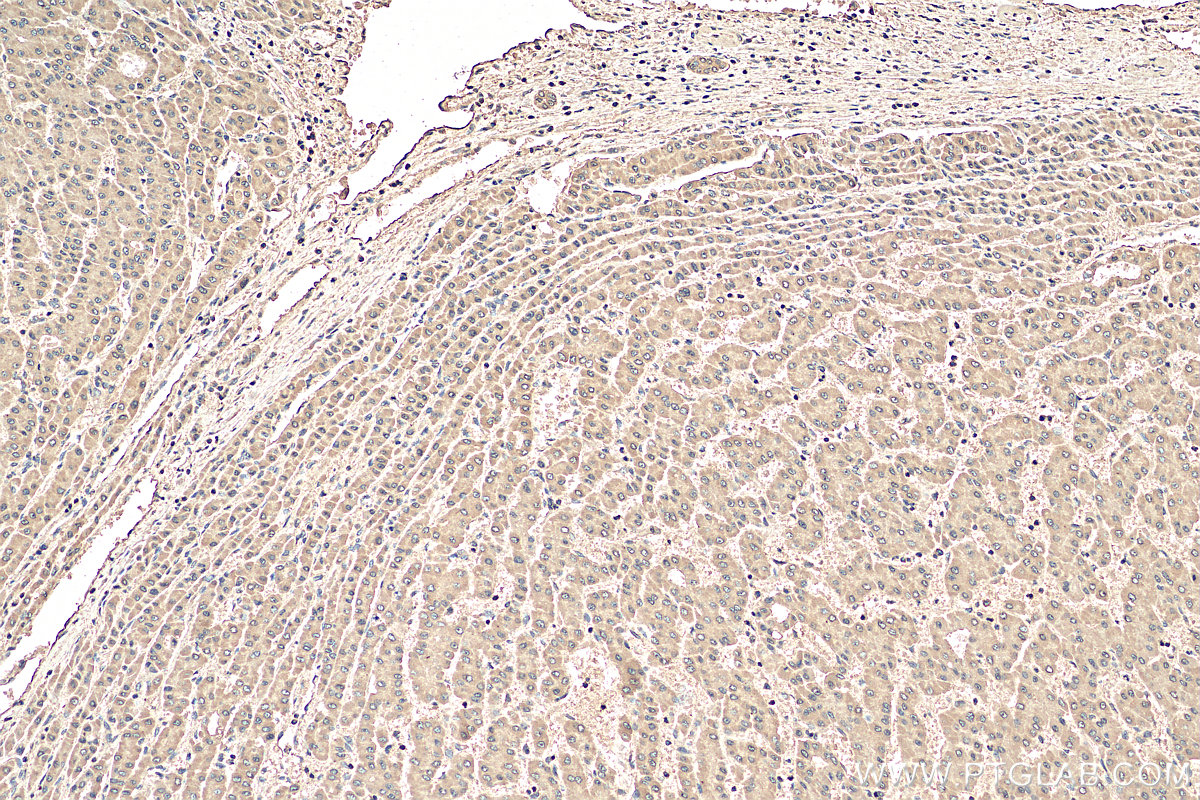 IHC staining of human liver cancer using 66100-1-Ig (same clone as 66100-1-PBS)