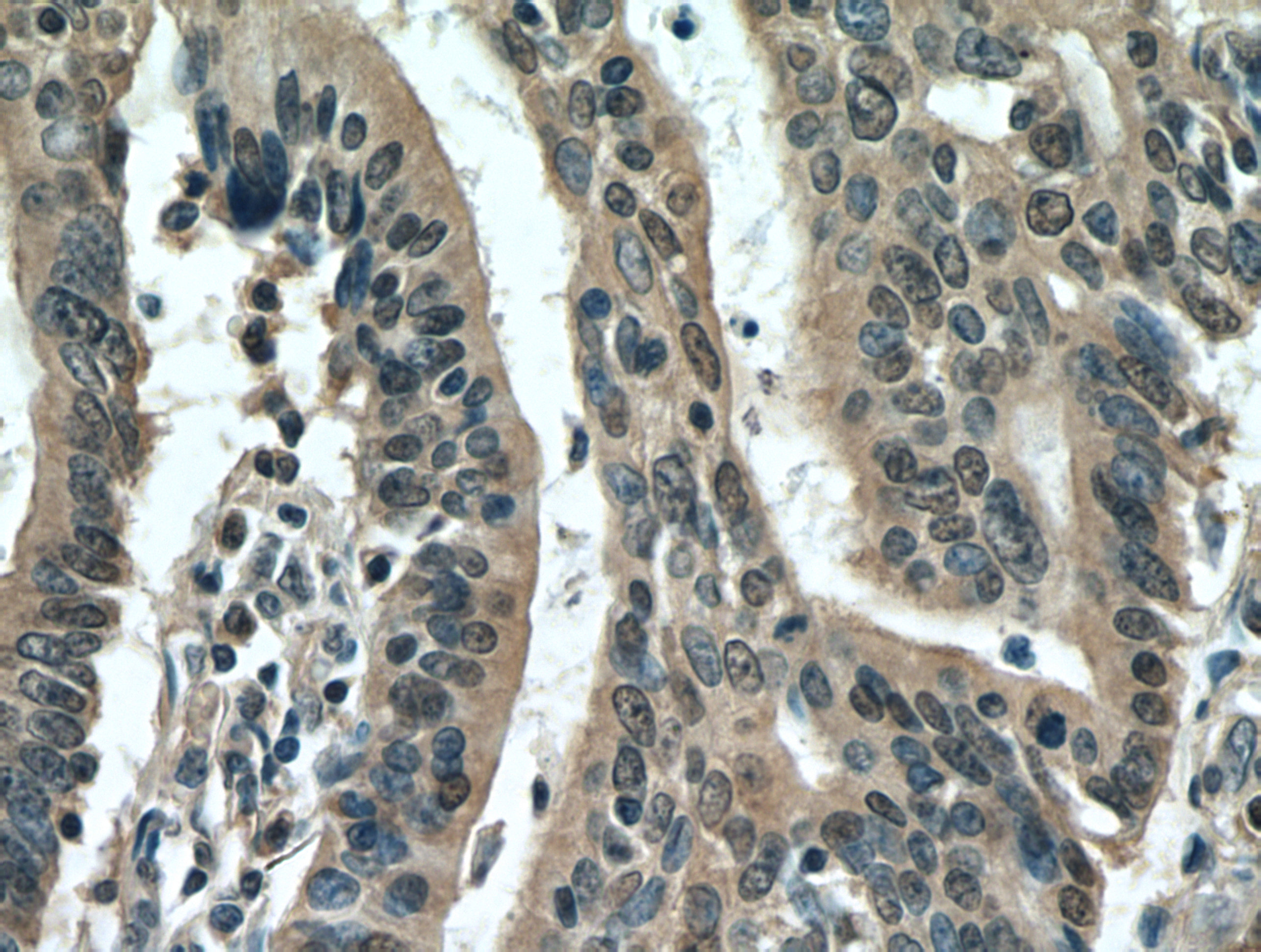 IHC staining of human endometrial cancer using 12456-1-AP