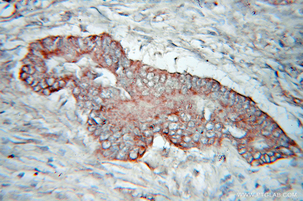 IHC staining of human colon cancer using 10951-1-AP