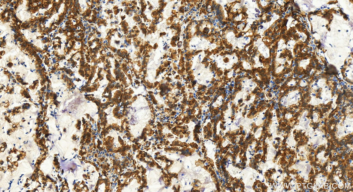 IHC staining of human stomach cancer using 11674-1-AP