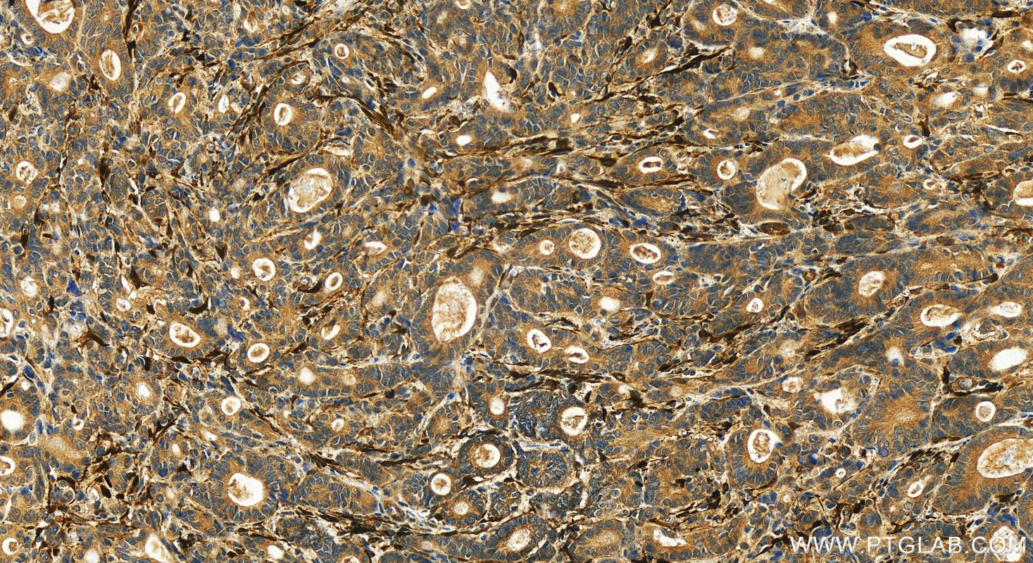 IHC staining of human stomach cancer using 13199-2-AP