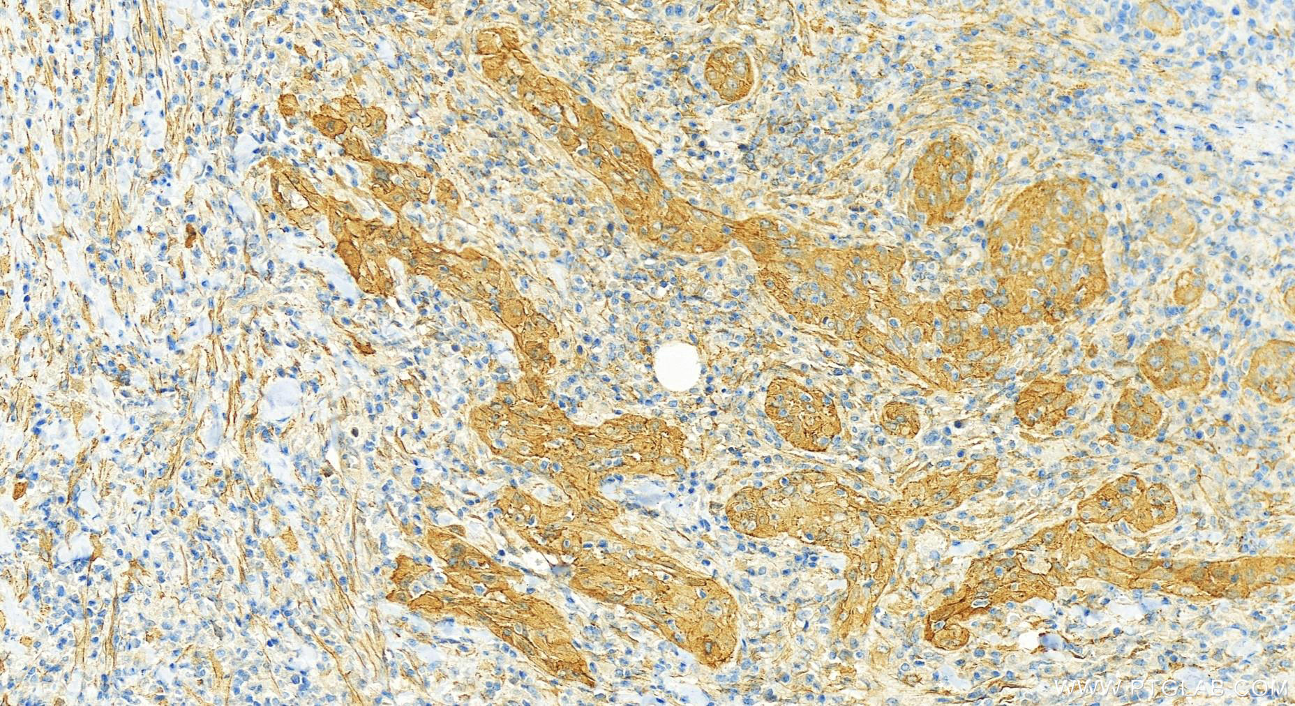 IHC staining of human skin cancer using 18543-1-AP