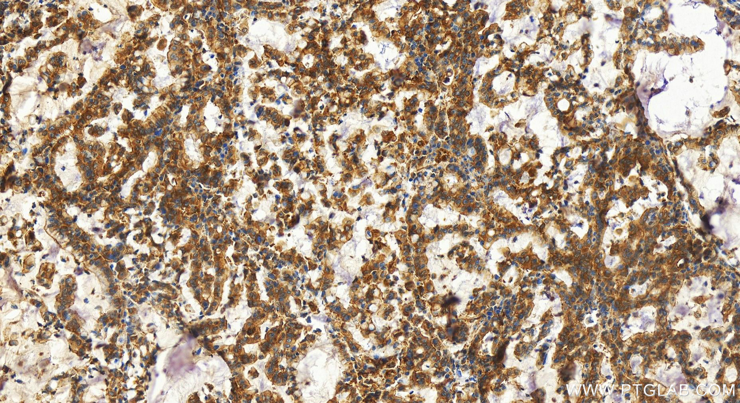 IHC staining of human stomach cancer using 10530-1-AP